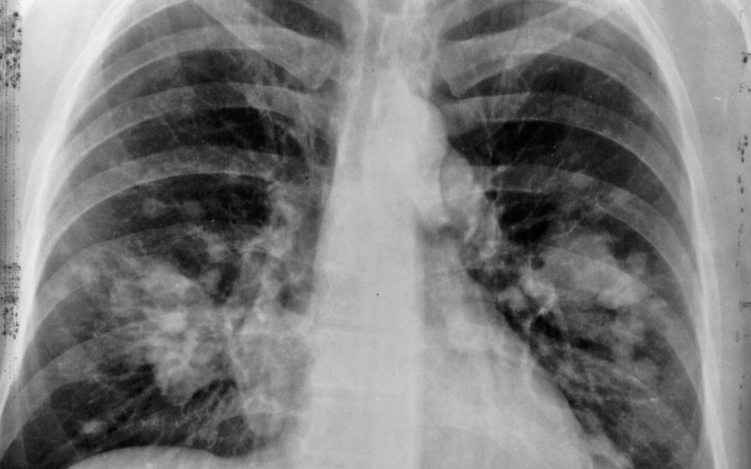 🎗 Layer X-ray detects lung cancer in time