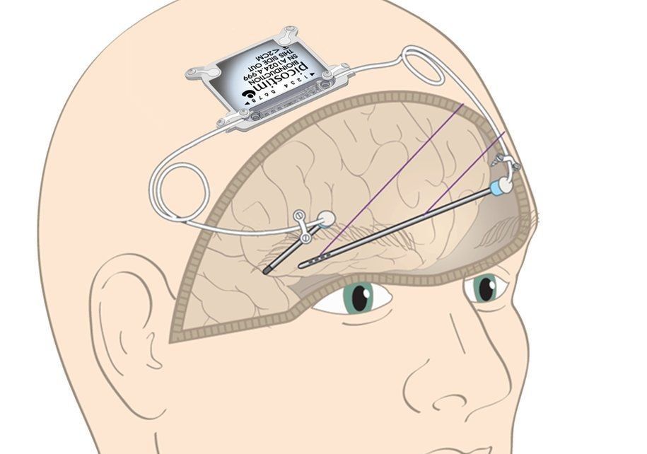 🧠 Tiny implant could turn back the clock for Parkinson’s patients